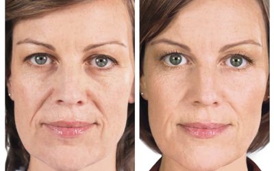 Sculptra – Now At Aesthetic Options!