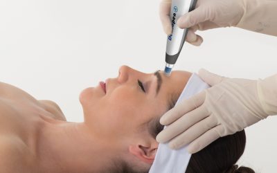 Micro-Needling Mother’s Day Special