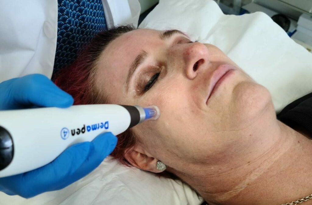 Microneedling is the perfect solution