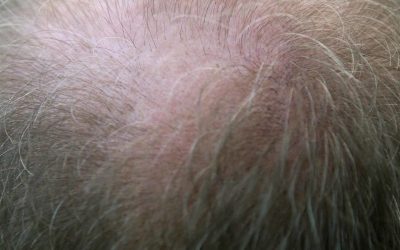 Hairloss