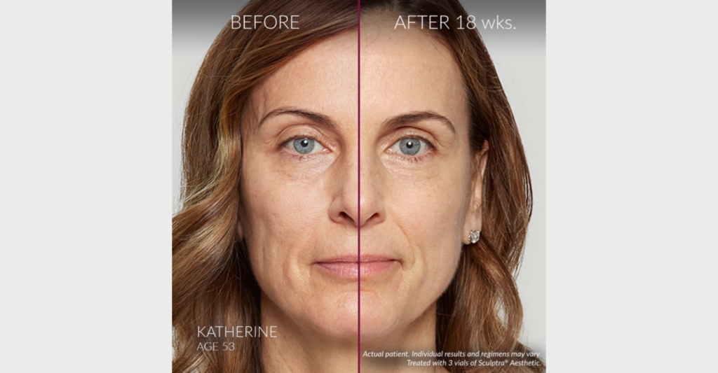 Sculptura Skin Boosting Treatment