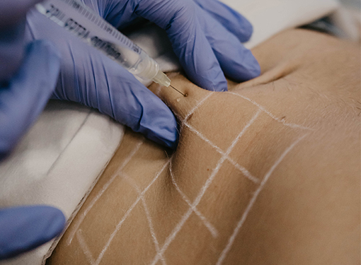 Lipolysis Injections - Aesthetic Options