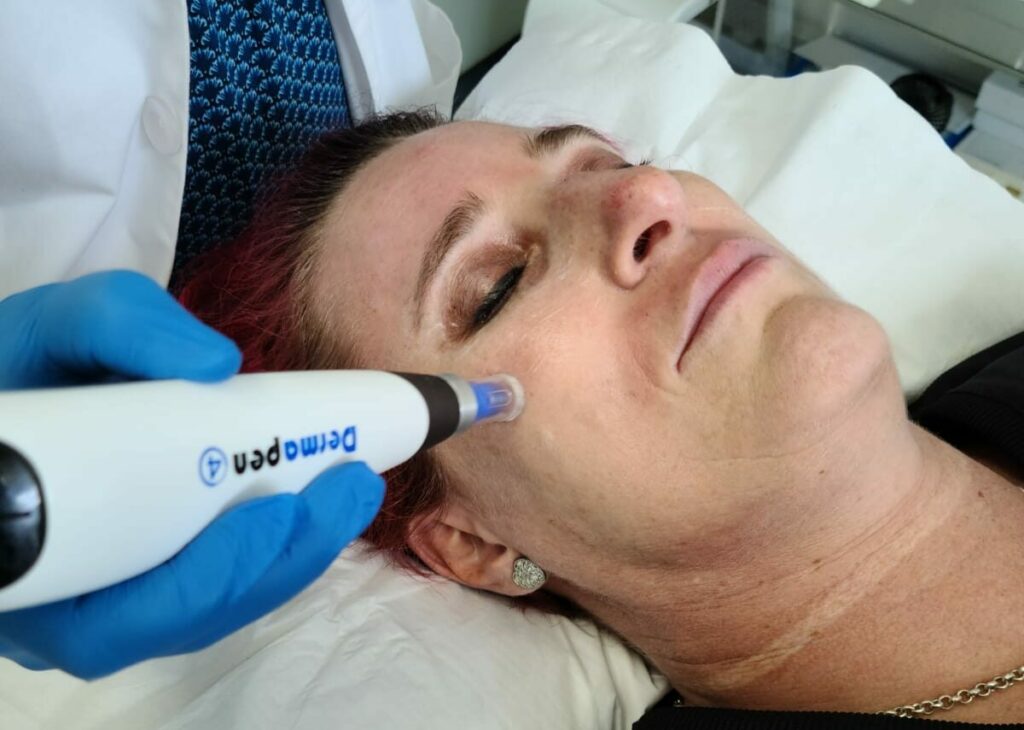 Microneedling is the perfect solution
