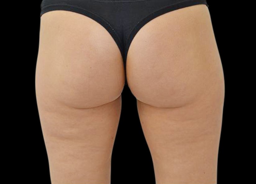 RF cellulite 1 after