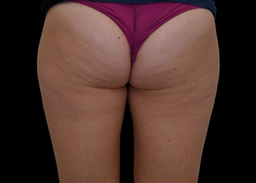 RF cellulite 2 before