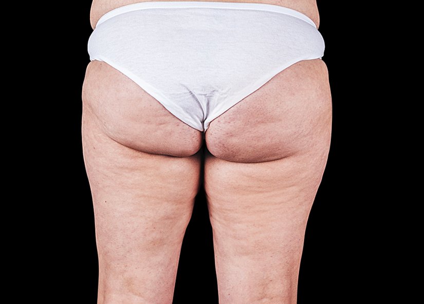 RF cellulite 3 after
