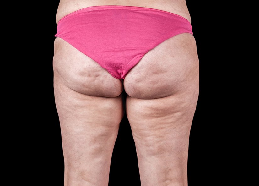 RF cellulite 3 before