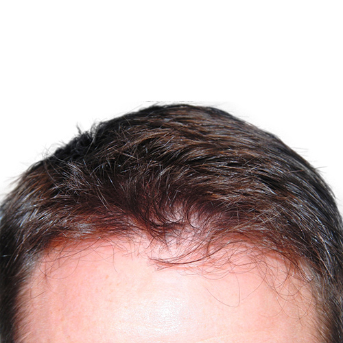 Robotic Assisted Hair Transplant - Aesthetic Options